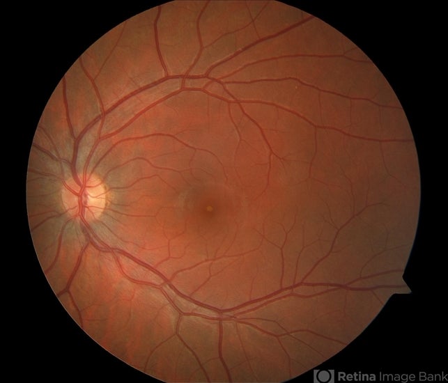 Bild, das eine solare Retinopathie zeigt – den abgedunkelten Bereich in der Mitte – eines 15-jährigen Mannes, der direkt in eine Sonnenfinsternis blickte 