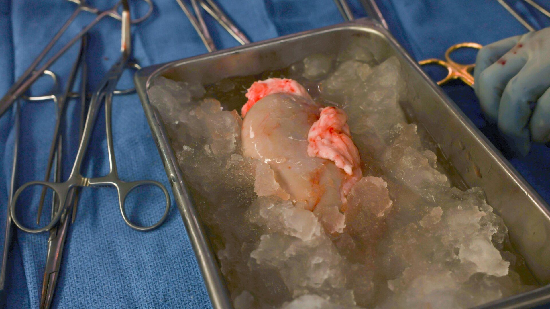 Slaymans neue Schweineniere liegt auf Eis und wird gleich transplantiert.