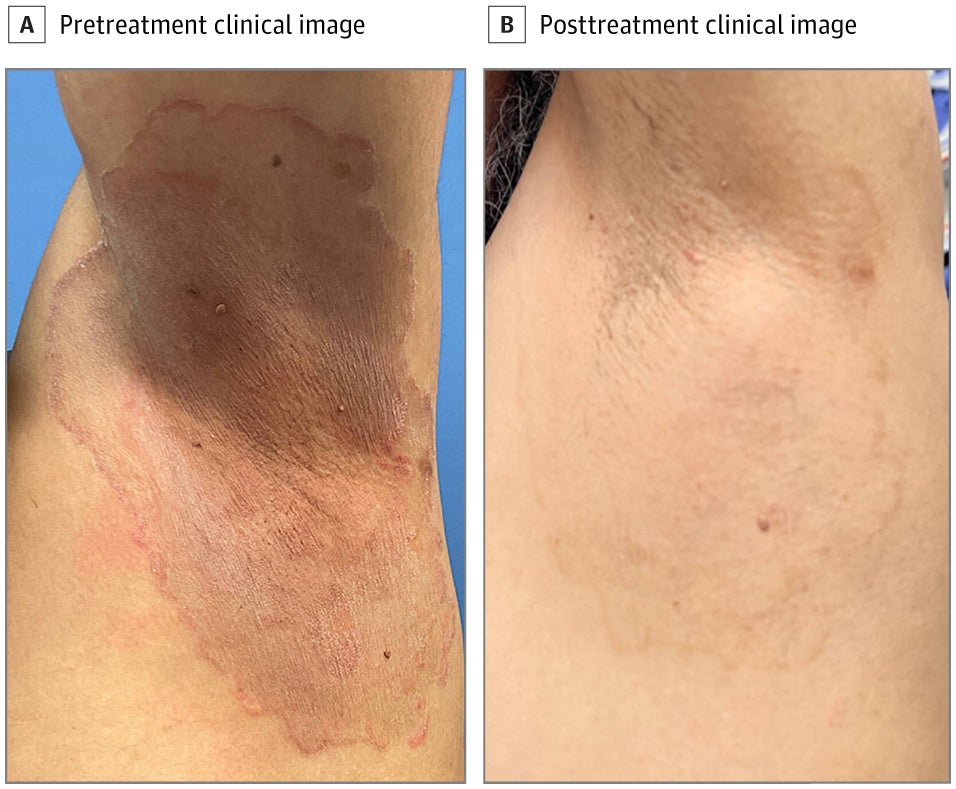 Vorher-Nachher-Bilder eines Patienten mit T. indotineae Infektion nach erfolgreicher  Behandlung, aus der neuesten Arbeit des Teams vom Mai .