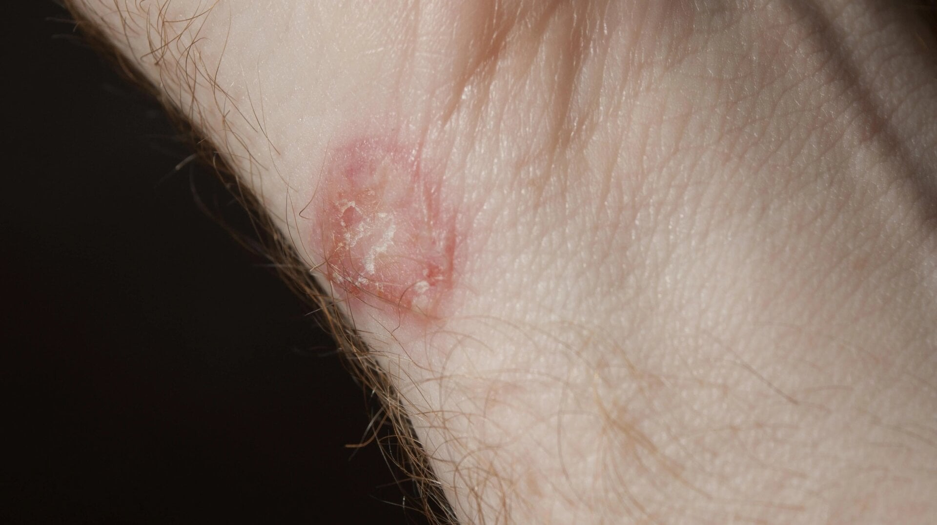 Eine leichte Ringelflechte-Infektion.
