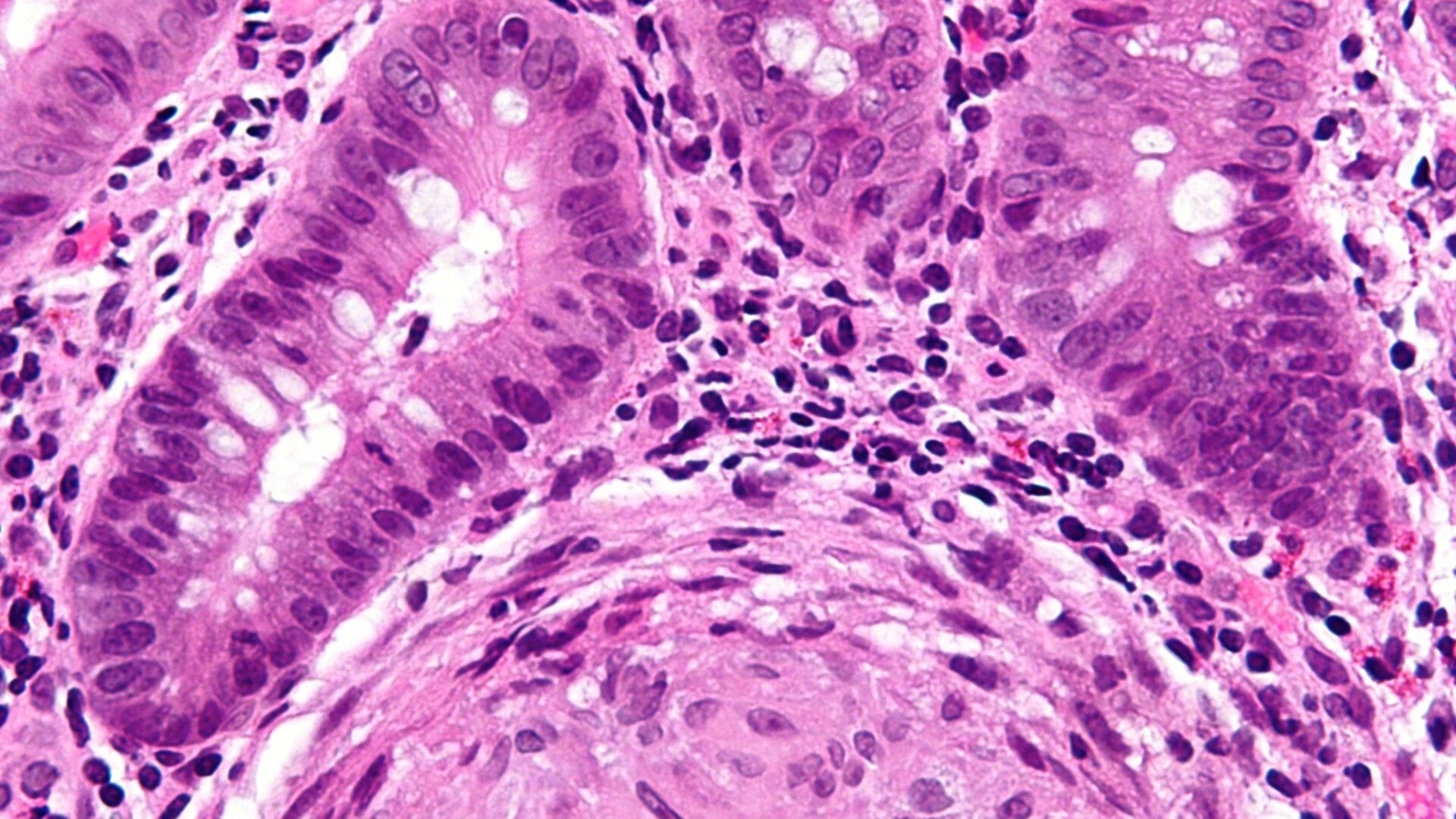 Eine sehr stark vergrößerte Mikrofotografie des Dickdarms einer Person mit Morbus Crohn.