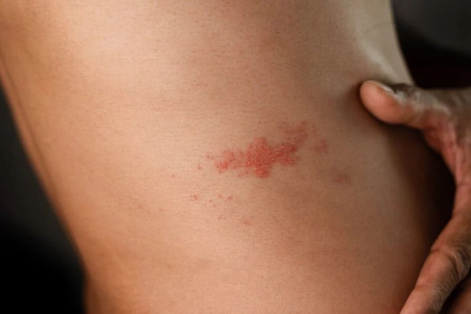 Unerwarteter Schutz: Wie die Gürtelrose-Impfung Herzinfarkten vorbeugen könnte