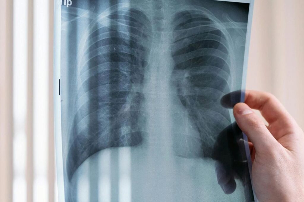 COPD