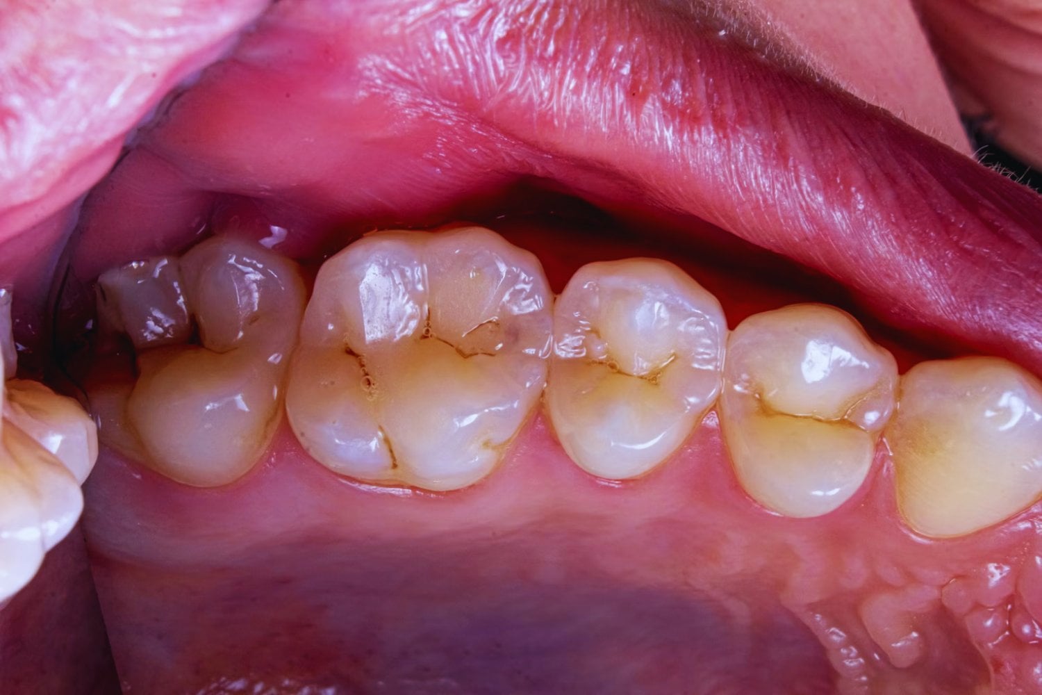 Teure Abzocke oder echte Vorsorge? Was wirklich hinter der professionellen Zahnreinigung steckt