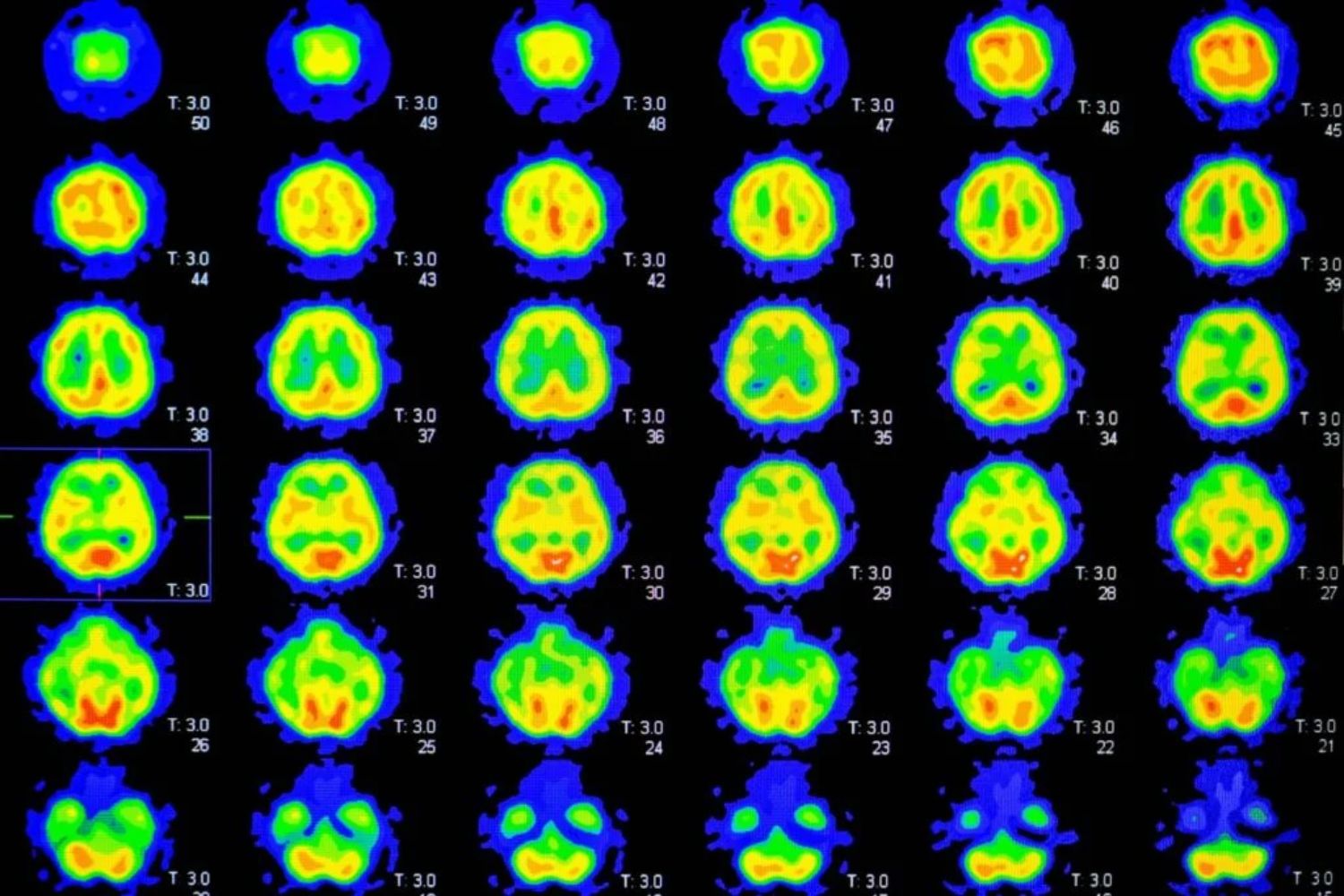 Mithilfe der Positronen-Emissions-Tomographie (PET) lässt sich heute durch die Erkennung von Amyloid-Beta-Plaques Ihr Alzheimer-Risiko bestimmen.